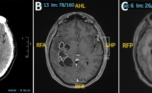 Doctors suspected man had brain cancer. He actually had worms.