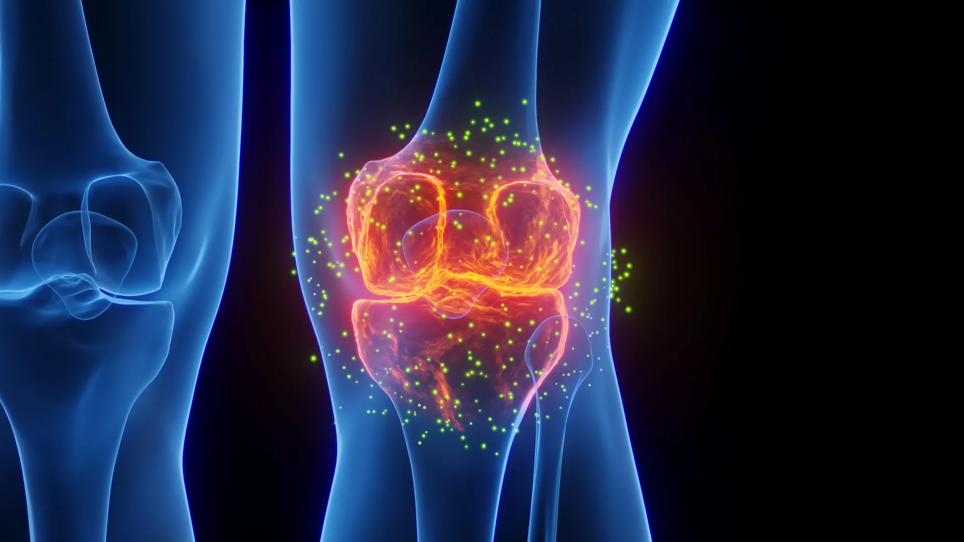 This emerging treatment is helping people avoid knee replacement surgery