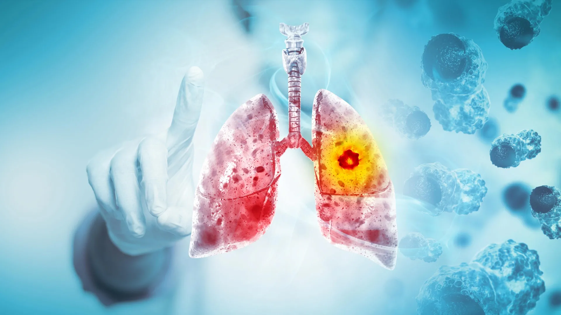 Scientists discover why this deadly lung cancer keeps coming back