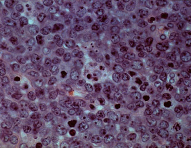 STAT+: Allogene Therapeutics’ CAR-T treatment eliminates residual cancer cells in B-cell lymphoma patients