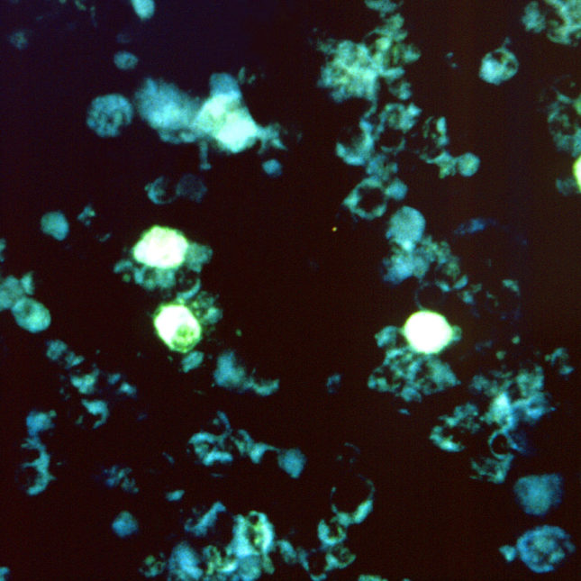STAT+: New study untangles how Epstein-Barr viral infection triggers immune response in multiple sclerosis