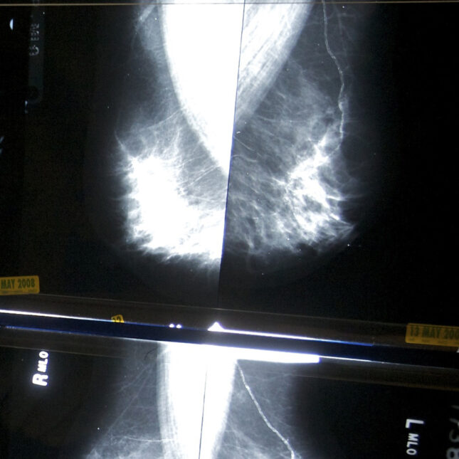 When should you get a mammogram? Conflicting advice makes it hard to know