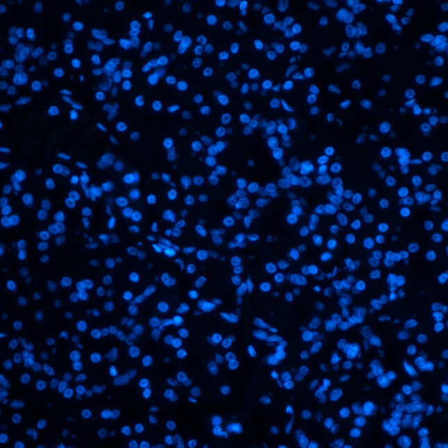 STAT+: Ahead of ASCO, all eyes on pancreatic cancer