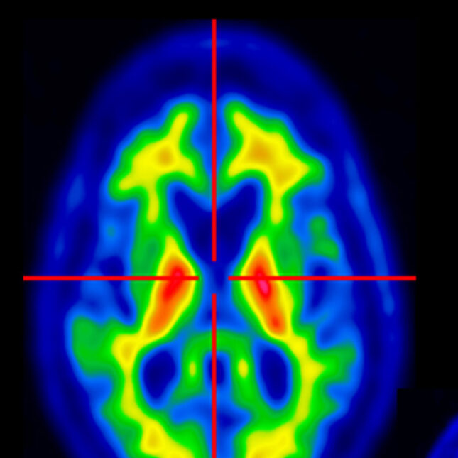 STAT+: Axsome wins FDA nod for Alzheimer’s agitation