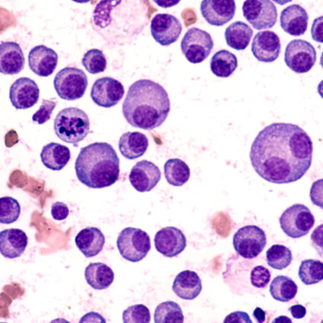 STAT+: In early trial, CAR-T results raise hope of preventing multiple myeloma in high-risk patients