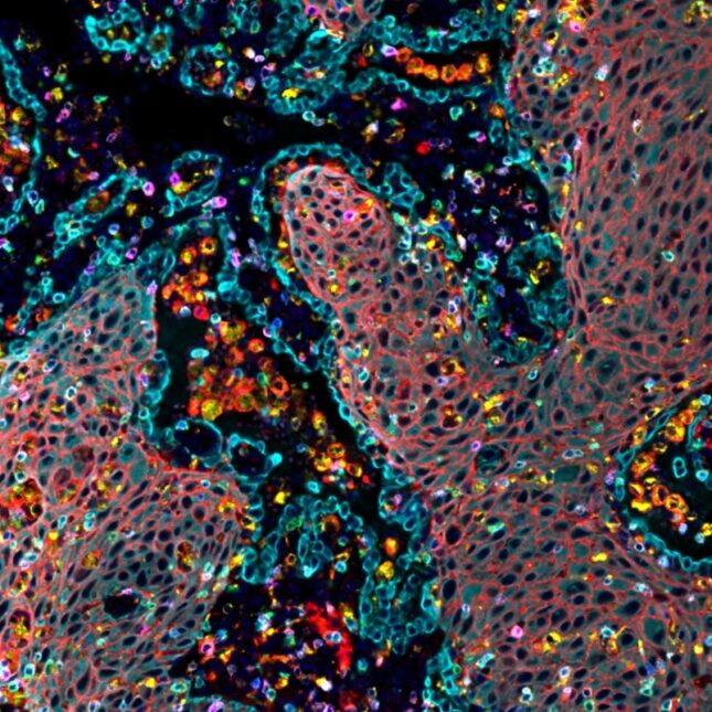 STAT+: Finally cracking KRAS as a druggable target