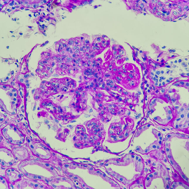 STAT+: 5 years after lupus breakthrough, CAR-T is still surprising autoimmunity researchers