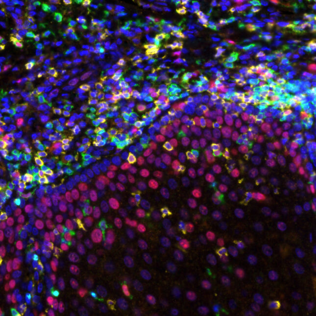 Ultra-low doses could bring costly cancer treatments to more patients in poorer countries