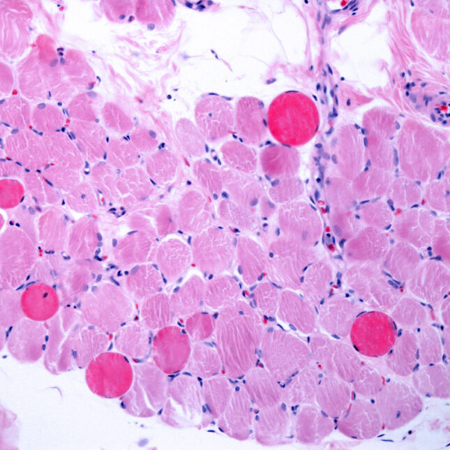 STAT+: Capricor Therapeutics accuses Nippon Shinyaku of slow-walking plans on Duchenne drug