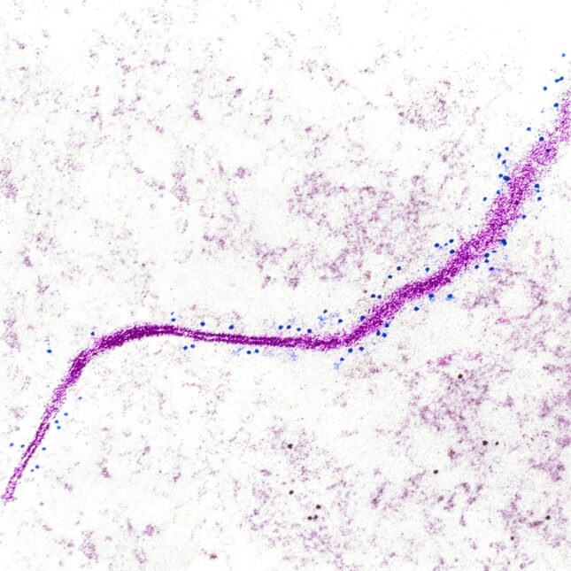 STAT+: Cancer cells can ‘barf’ proteins onto their cell surface. That may create new targets for immunotherapies