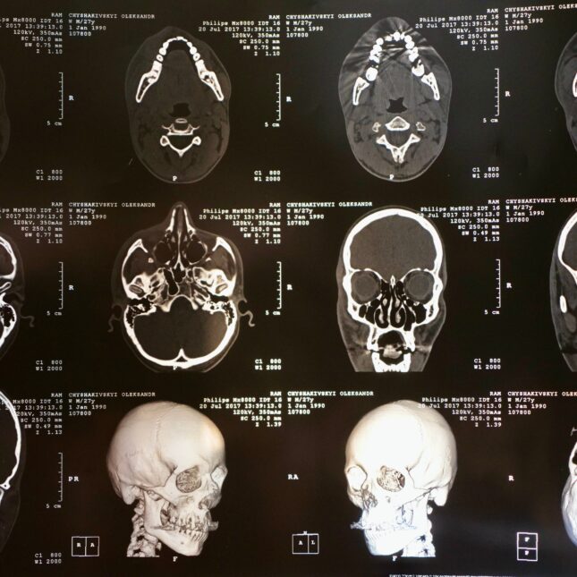 STAT+: With successful trials, Roche takes its MS drug to regulators, but safety questions loom