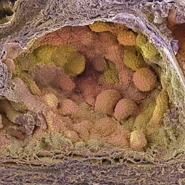 STAT+: For prostate cancer patients set on surgery, new hormone regimen may improve outcomes, study finds