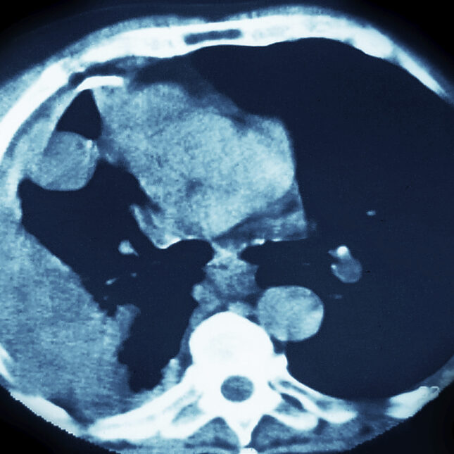 STAT+: Akeso and Summit’s ivonescimab extends survival in squamous cell lung cancer