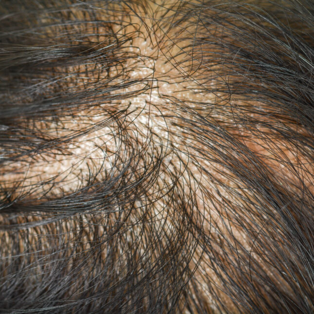 STAT+: Eli Lilly dives into hair loss treatments with investment in AI startup Absci